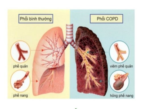 COPD.jpg