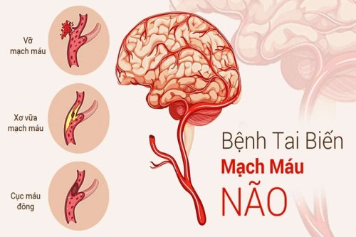 tai biến 1.jpg