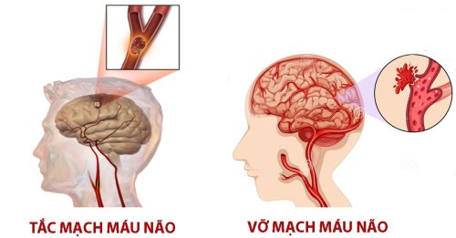 Tai biến 2.jpg