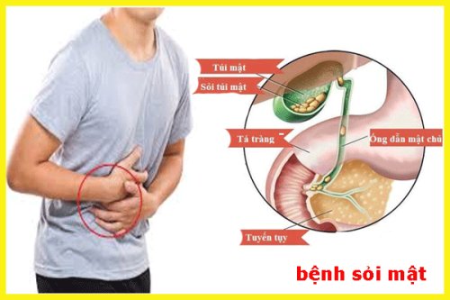 sỏi mật.gif