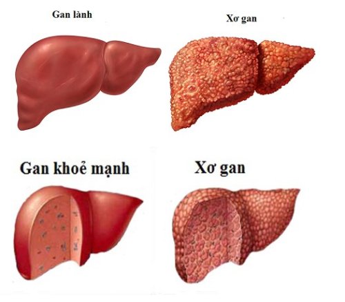 xơ gan.jpg