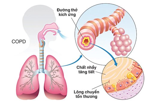 Phổi 1.jpg